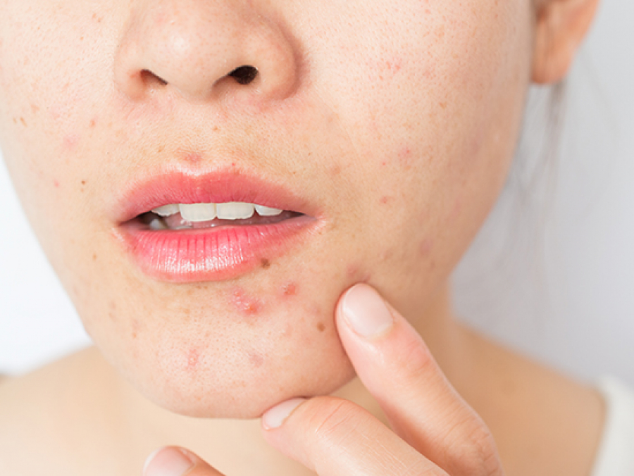 Dry acne-prone skin