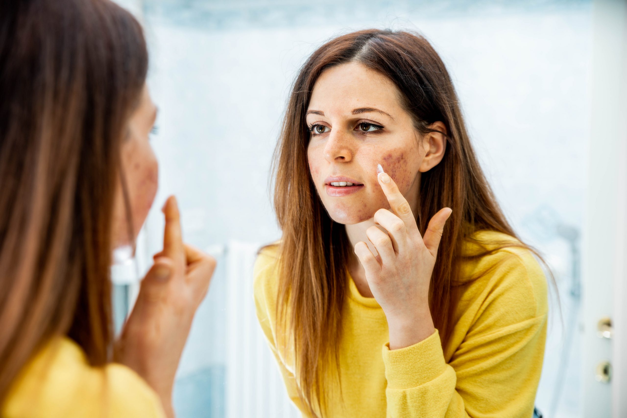 Does Retinol Get rid of Acne Scars? - Okka Beauty